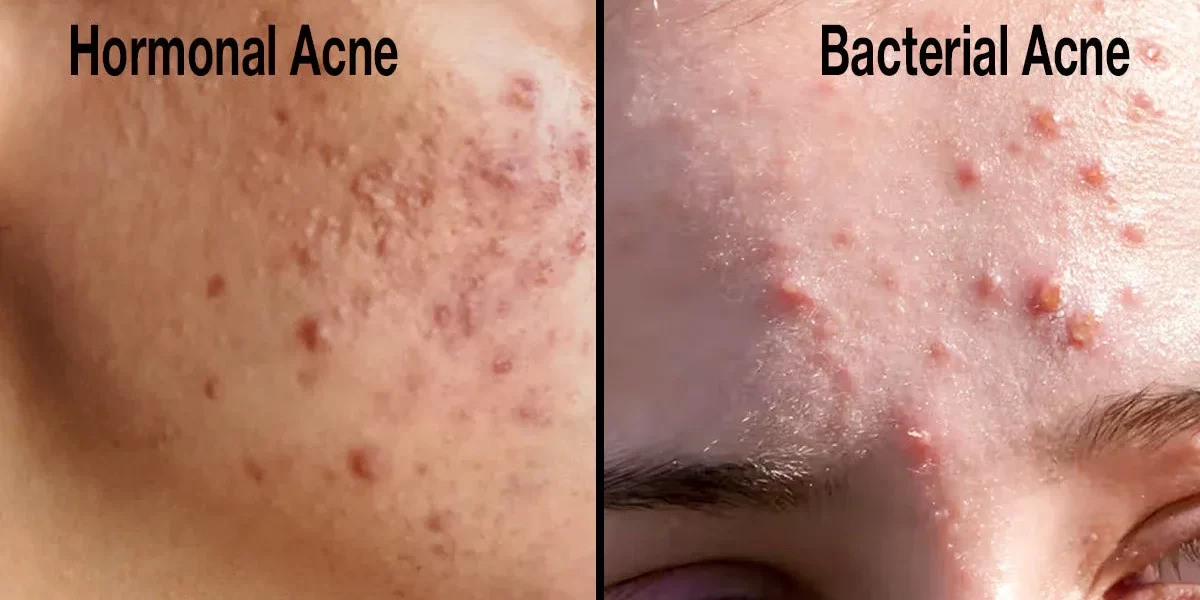 harmonal_acne_vs_Bacterial_Acne_feature_
