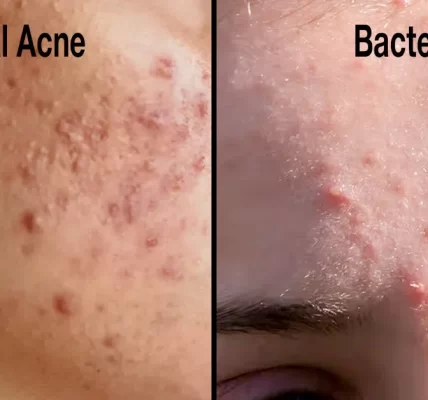 harmonal_acne_vs_Bacterial_Acne_feature_