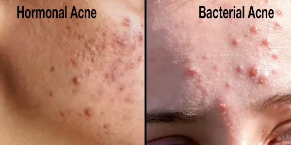 harmonal_acne_vs_Bacterial_Acne_feature_