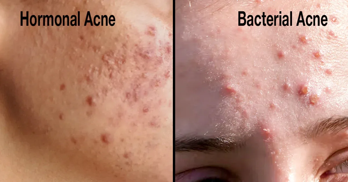 harmonal_acne_vs_Bacterial_Acne_feature_
