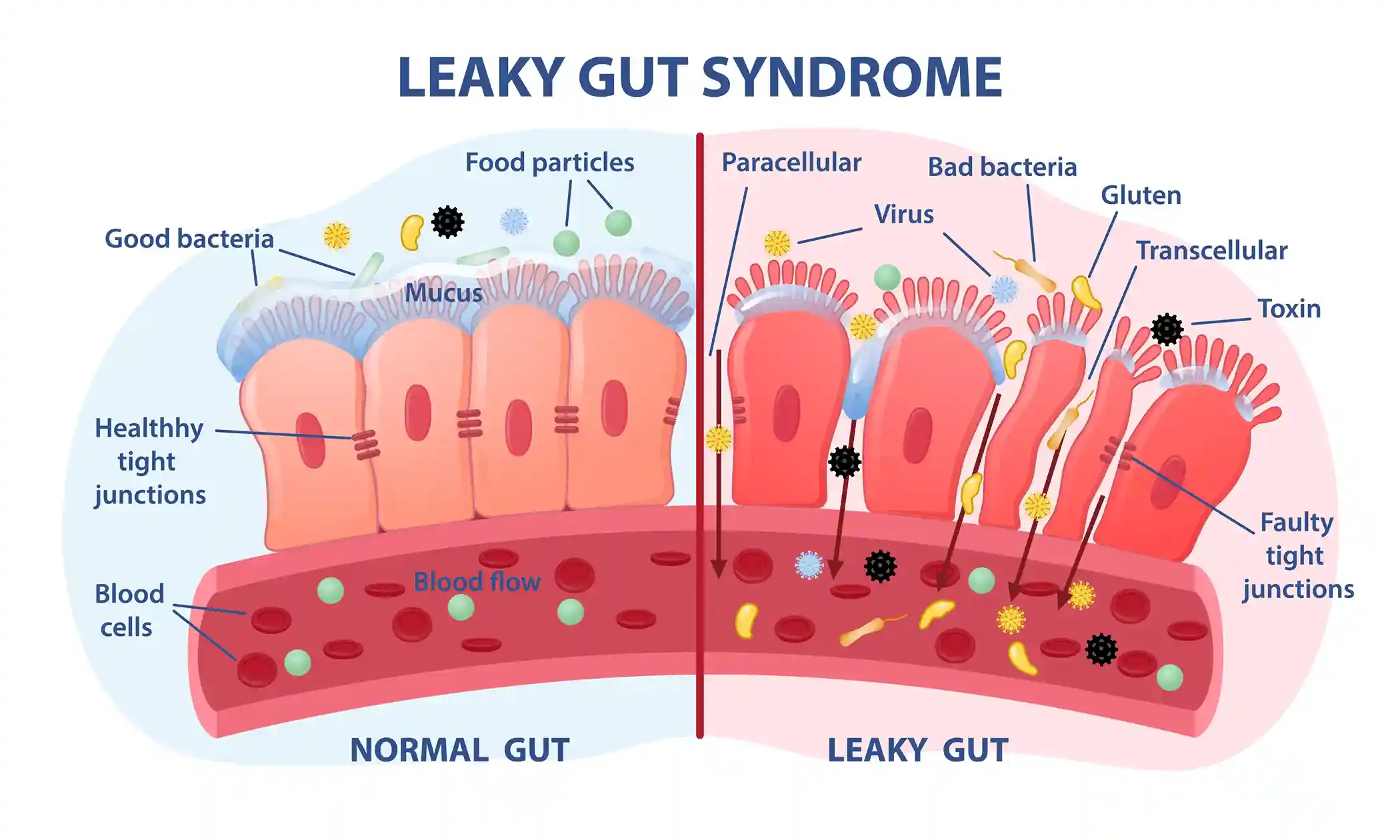 gut-imbalance